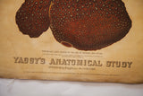 Yaggy's 19th century chart detail: 'hob-nailed liver' text and 1885 copyright.